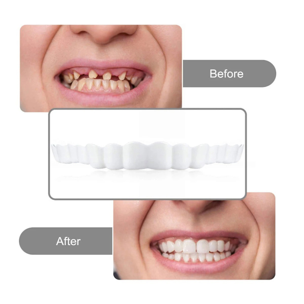 Snap On Smile 